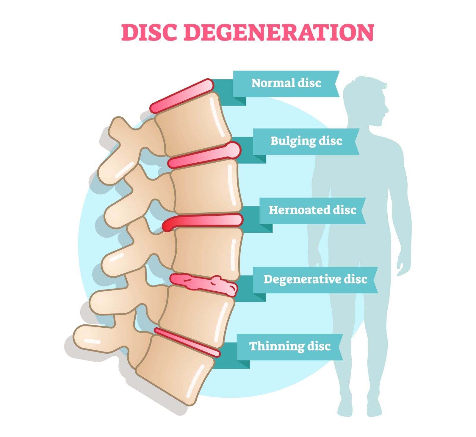 The 3 Stages Of Degenerative Disc Disease | New Jersey 